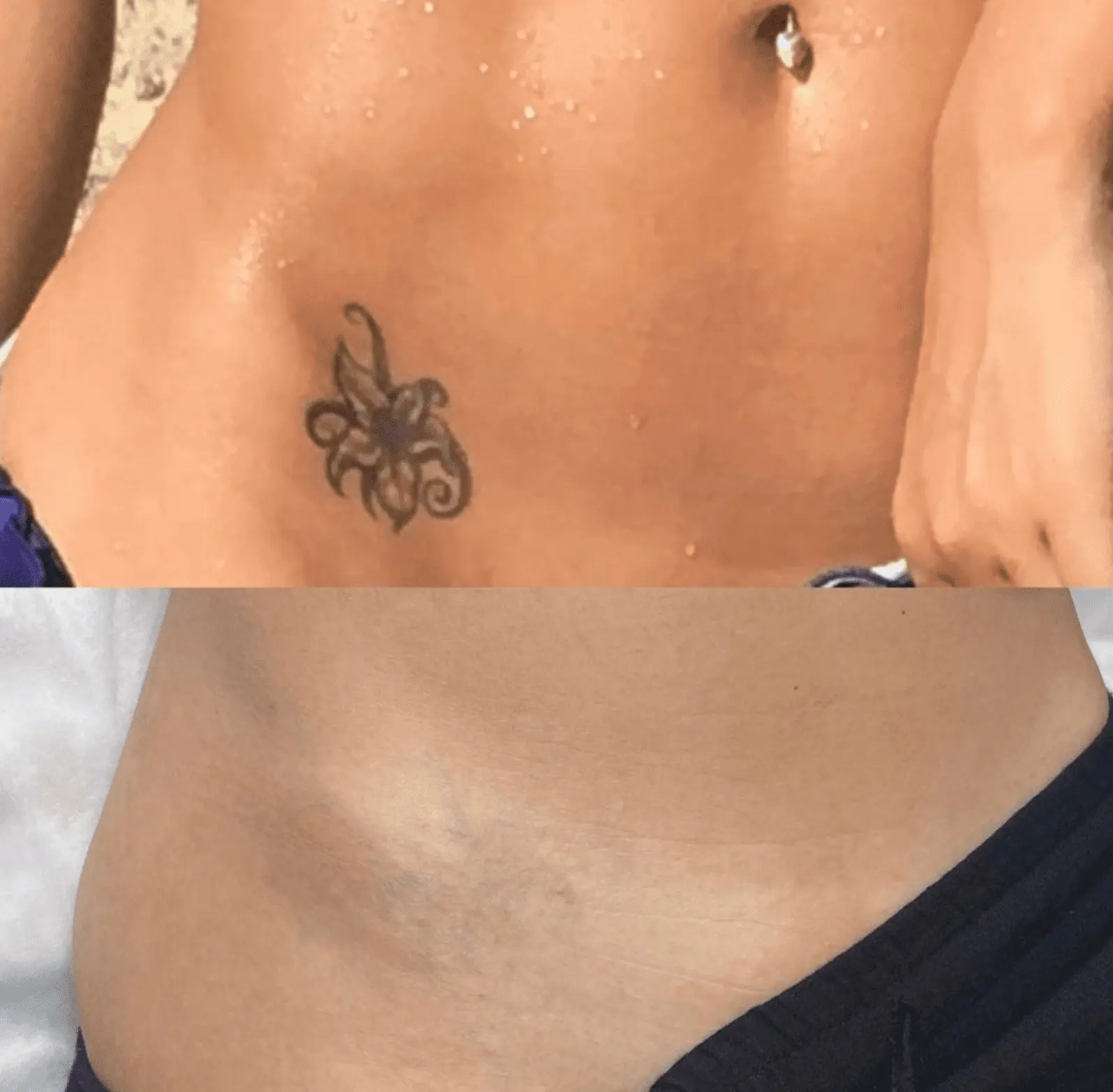 before after tattoo removal