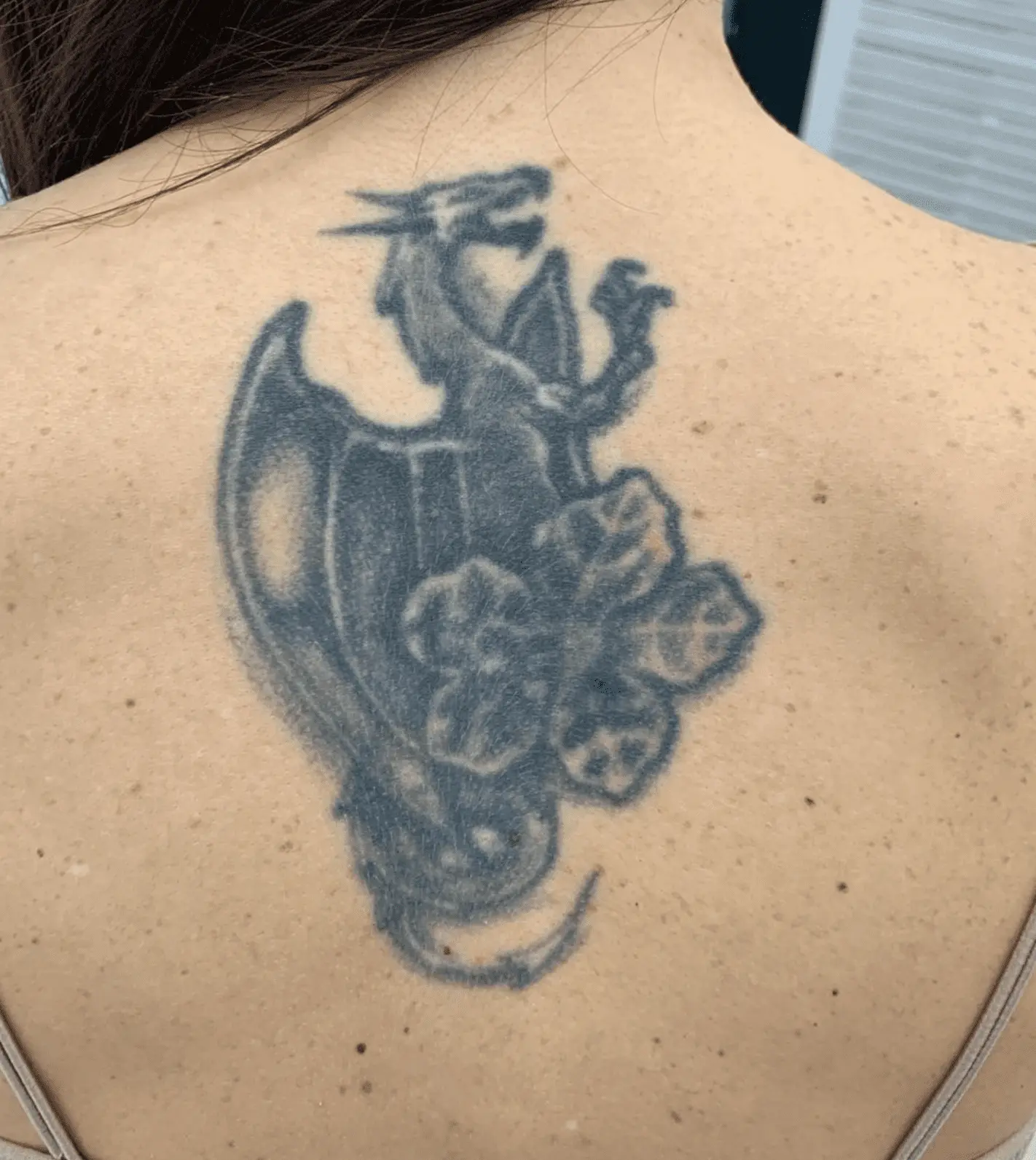 before and after laser tattoo removal
