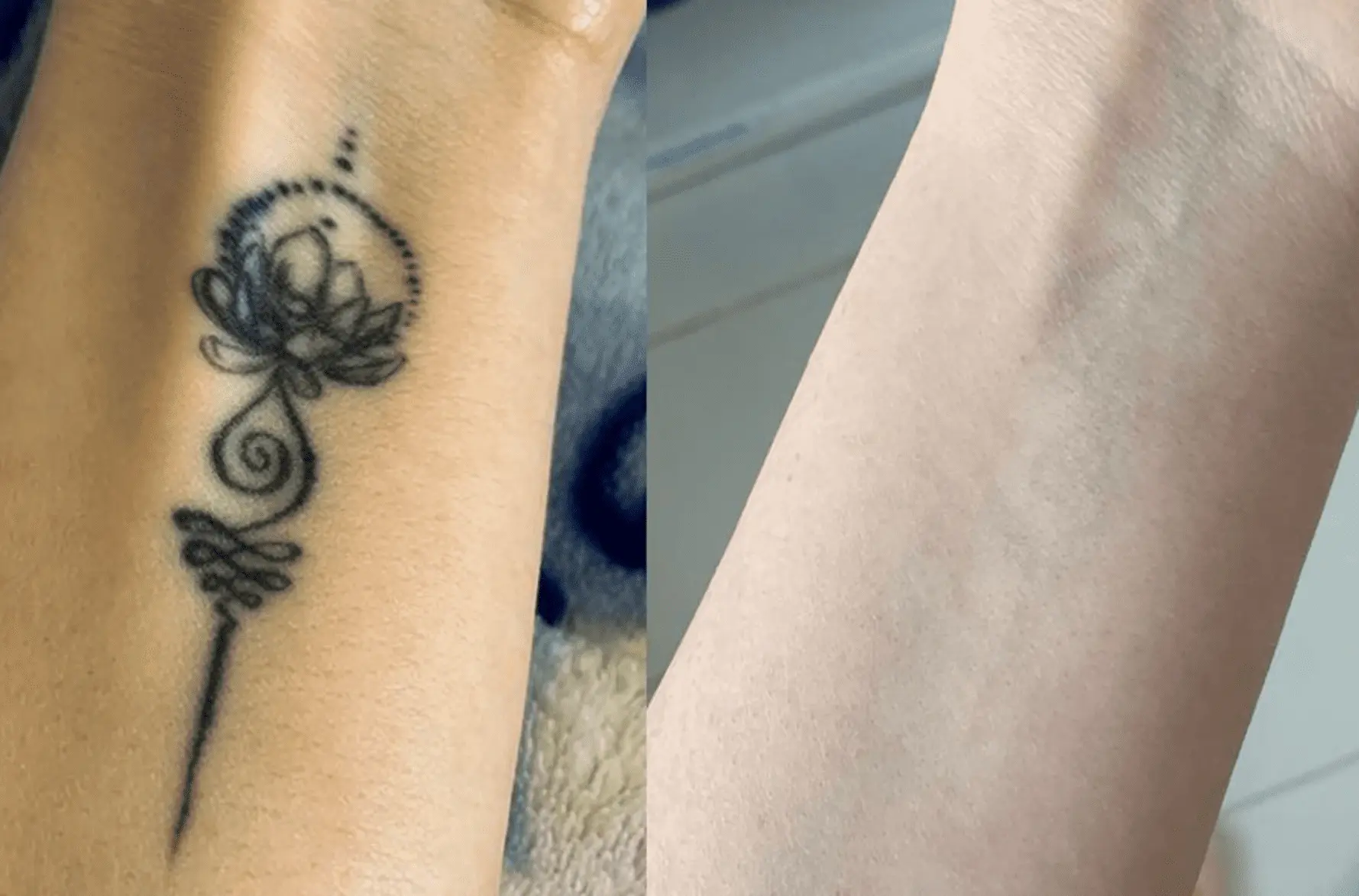 before and after of tattoo removal
