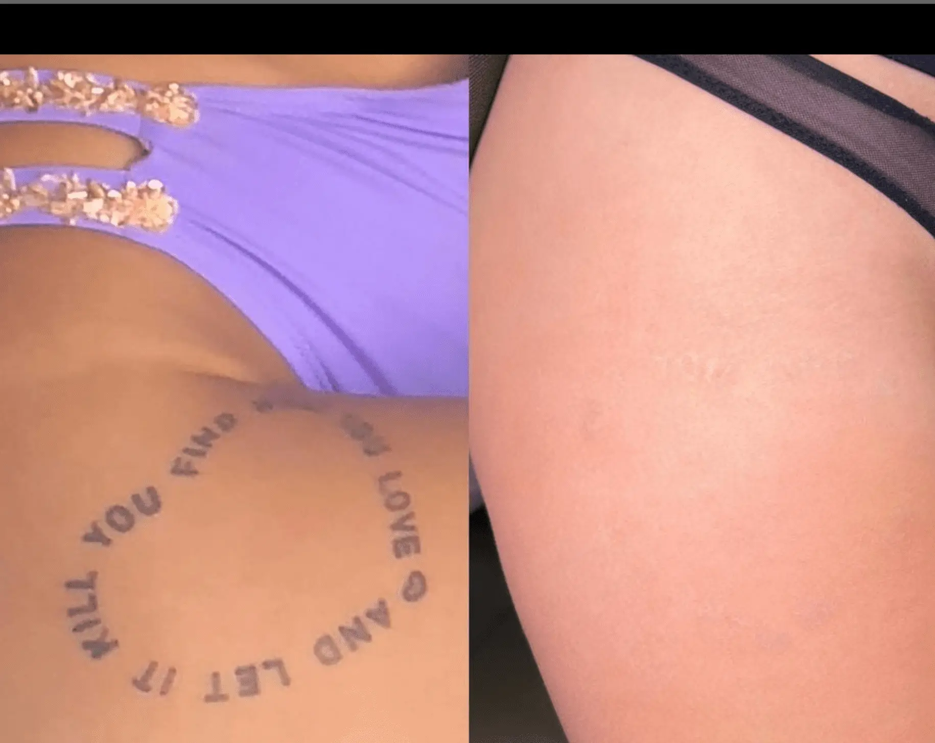 before and after tattoo removal