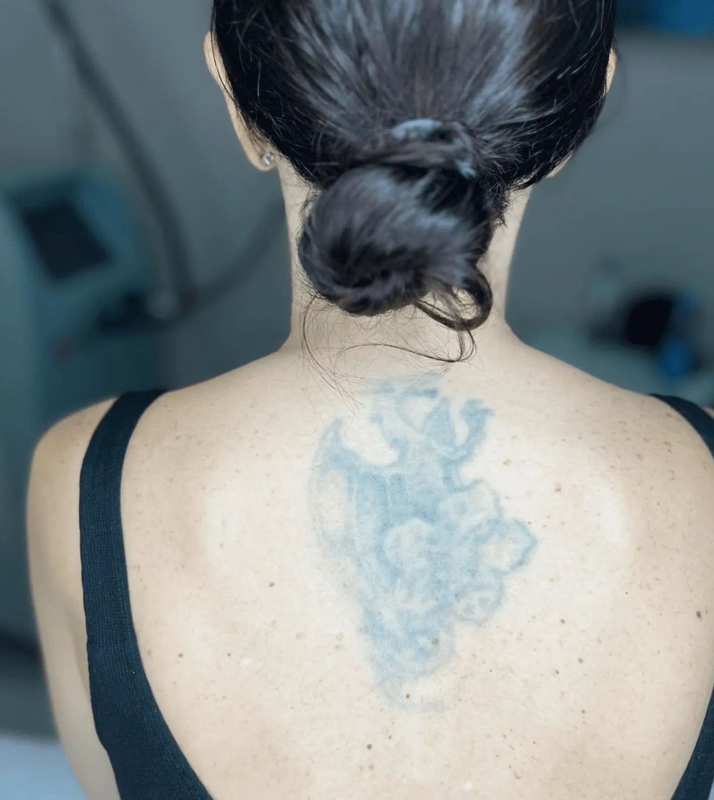 laser tattoo removal before and after
