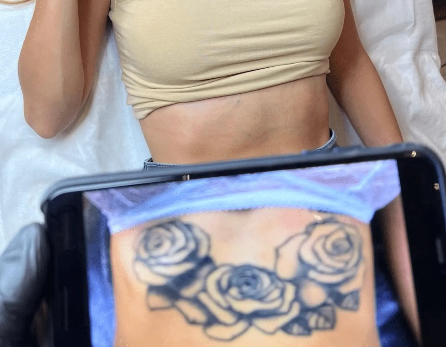 tattoo after removal