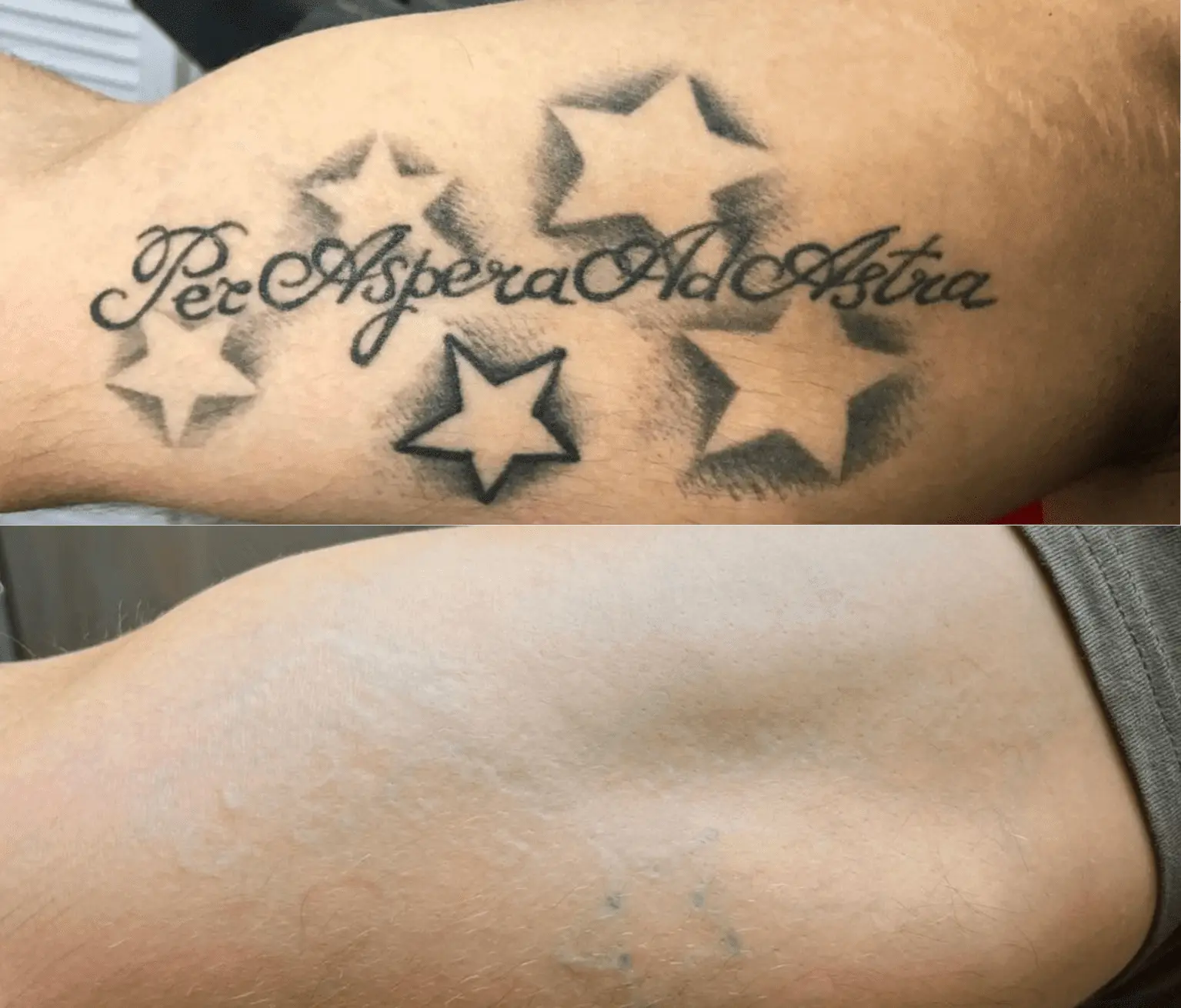 tattoo laser removal before and after