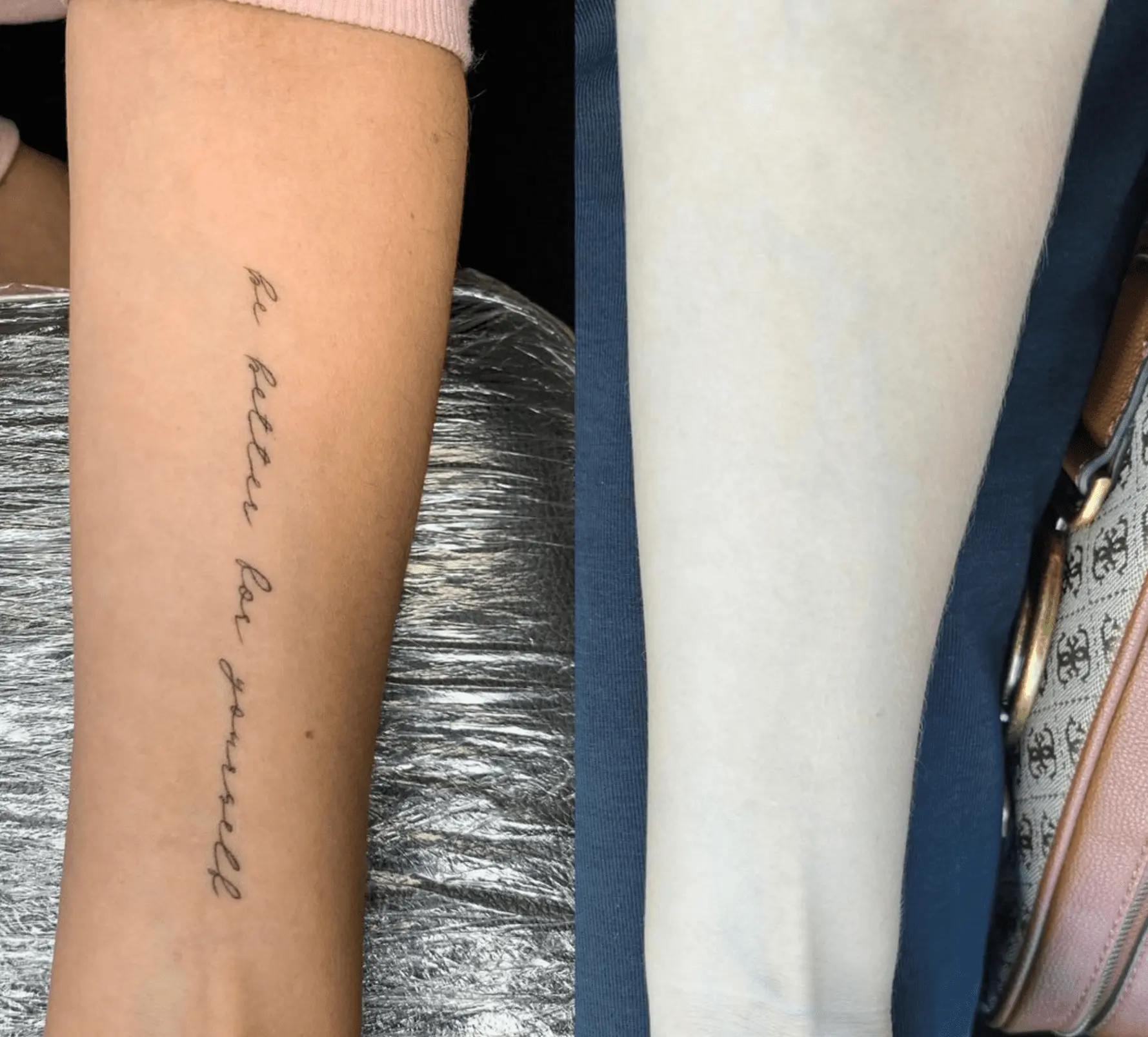 tattoo removal after