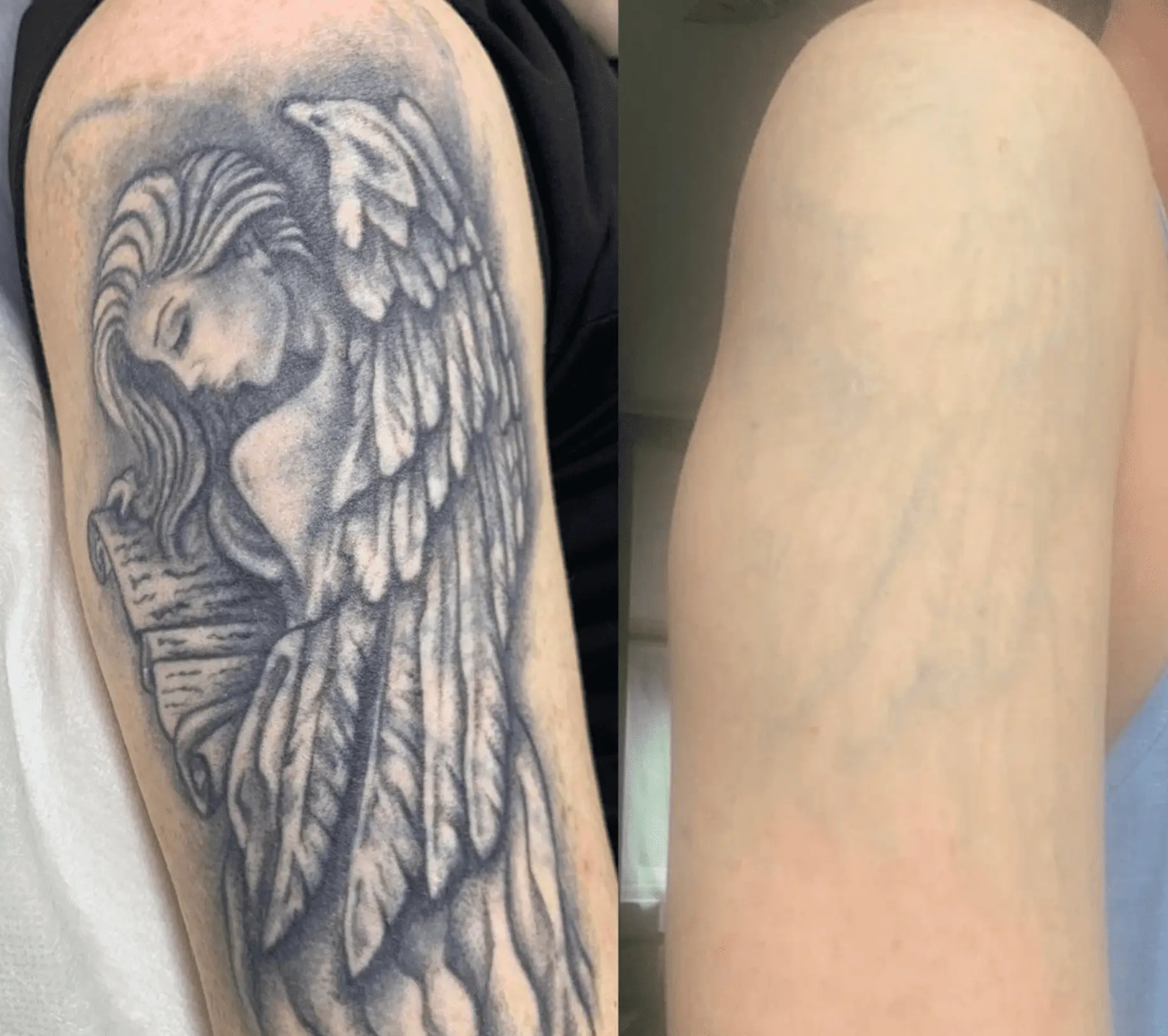 tattoo removal before after