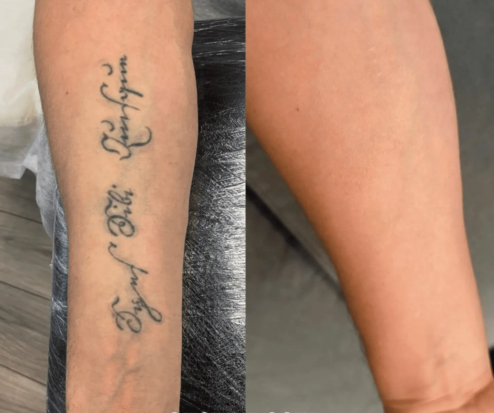 tattoo removal before and after photos