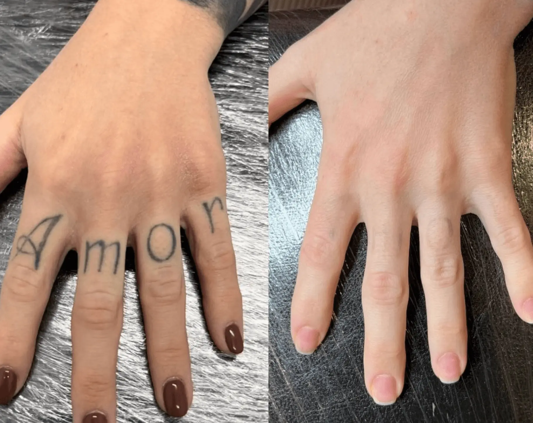 tattoo removal before and after pics