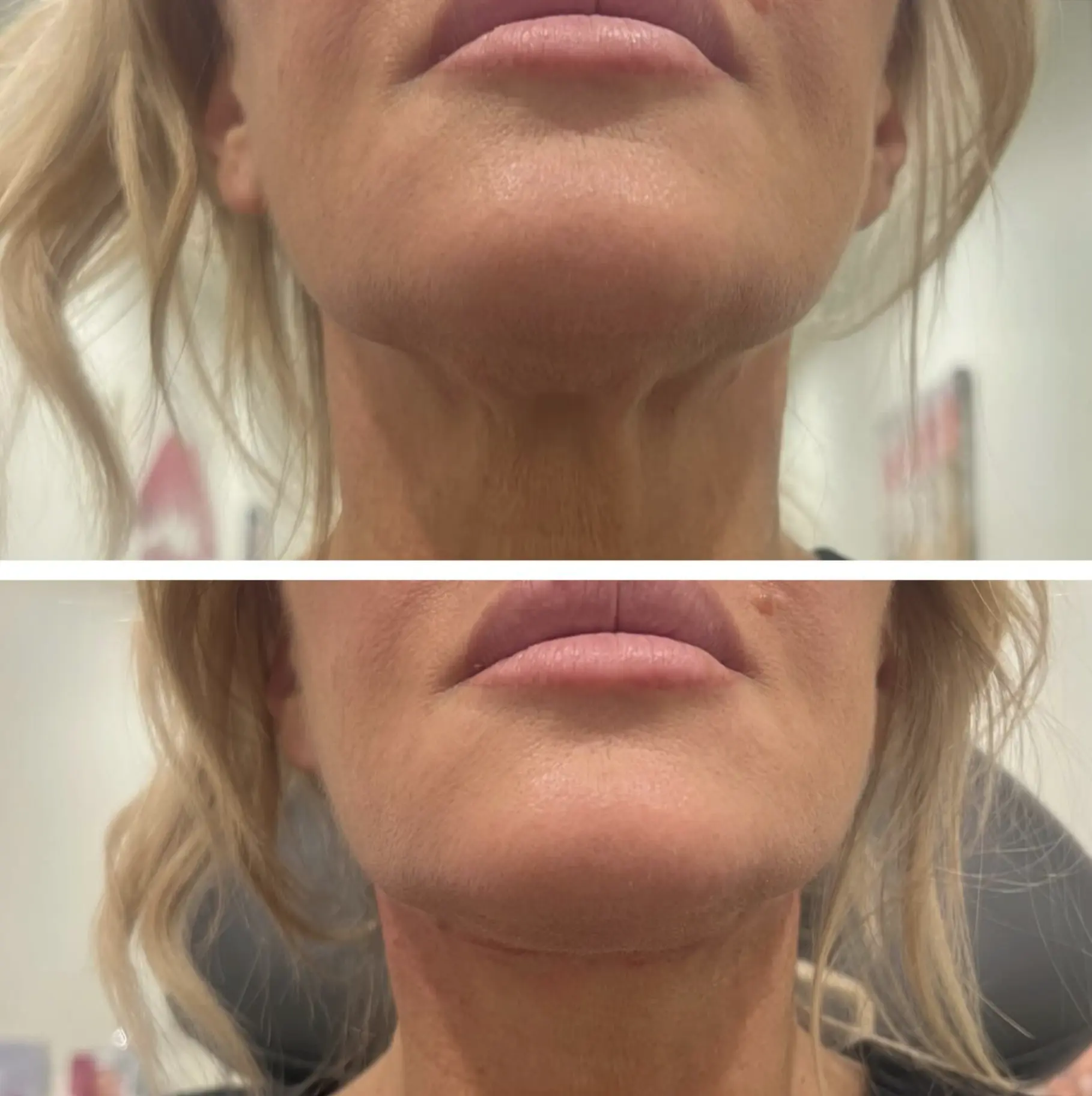 best non invasive neck lift treatments