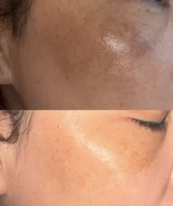 best skincare for melasma with frequent sweating