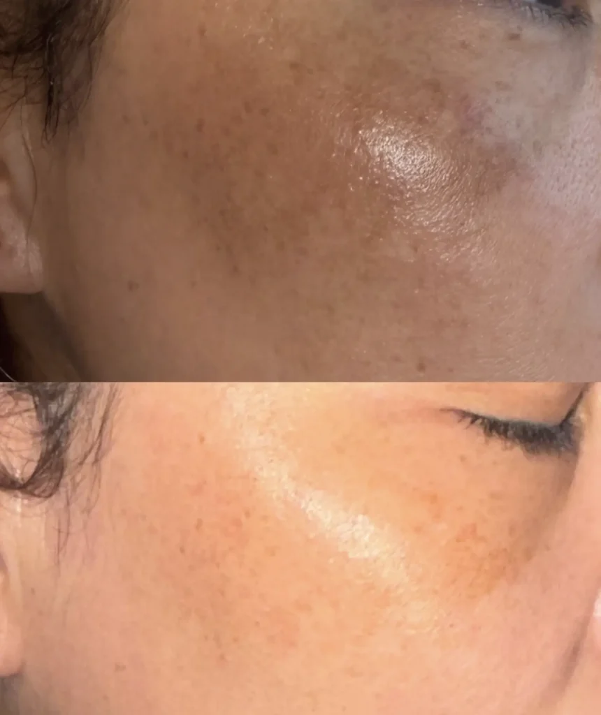 best skincare for melasma with frequent sweating