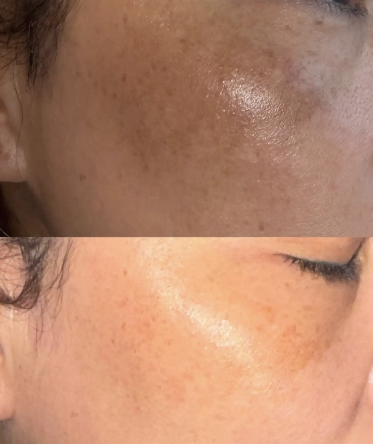 best skincare for melasma with frequent sweating