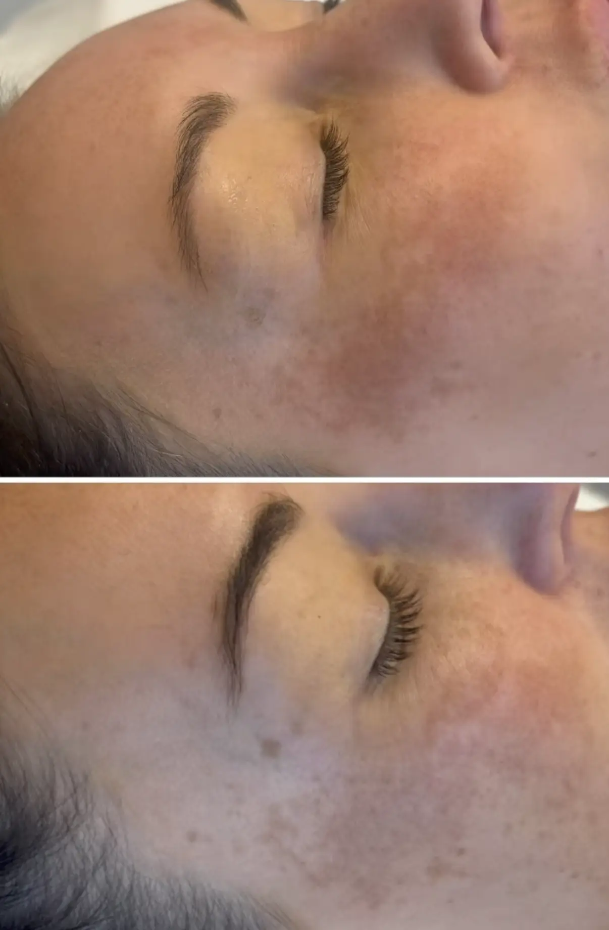 can exercise worsen melasma pigmentation