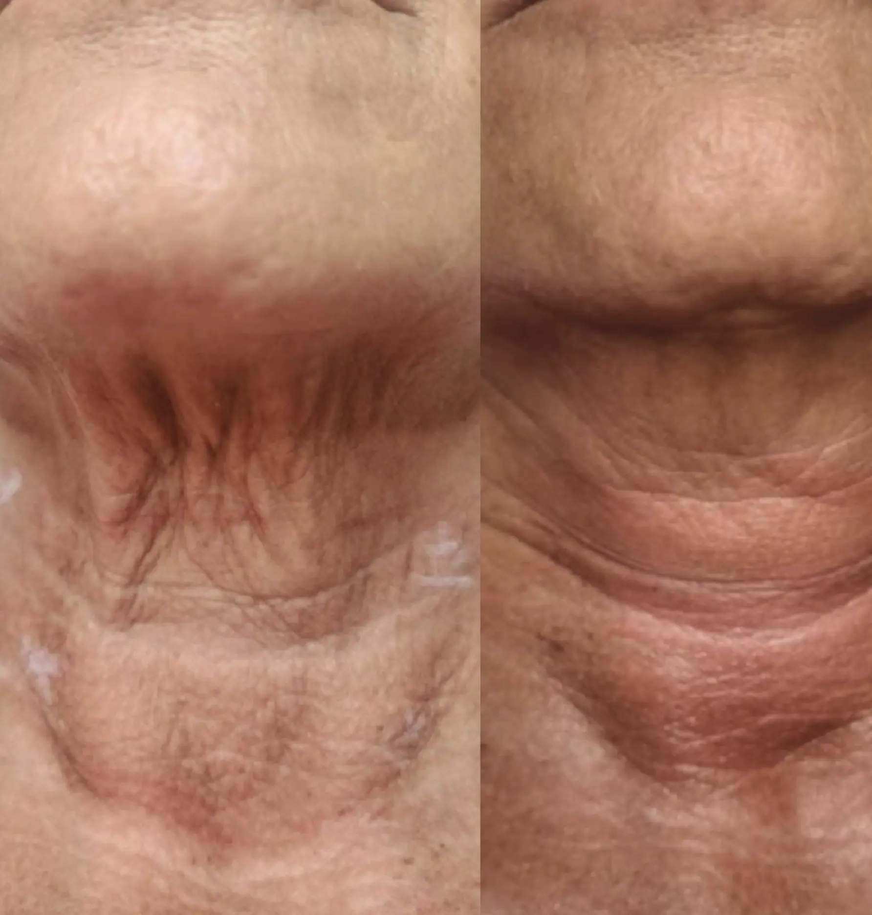 can you fix sagging neck without surgery