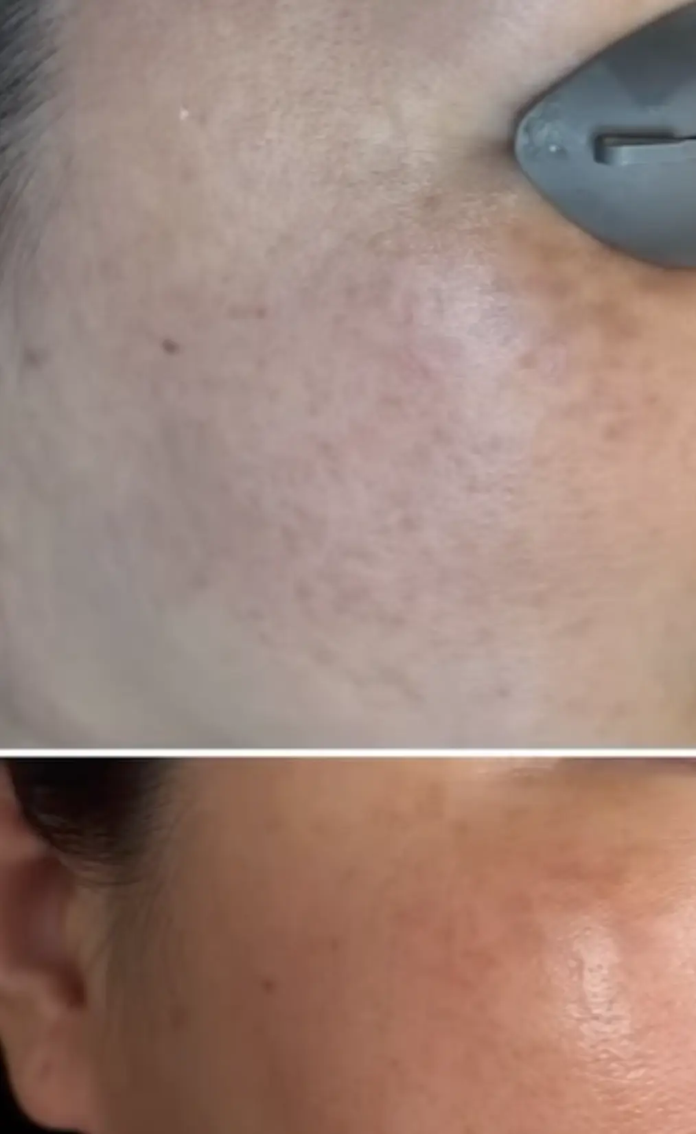 heat triggered hyperpigmentation prevention gym