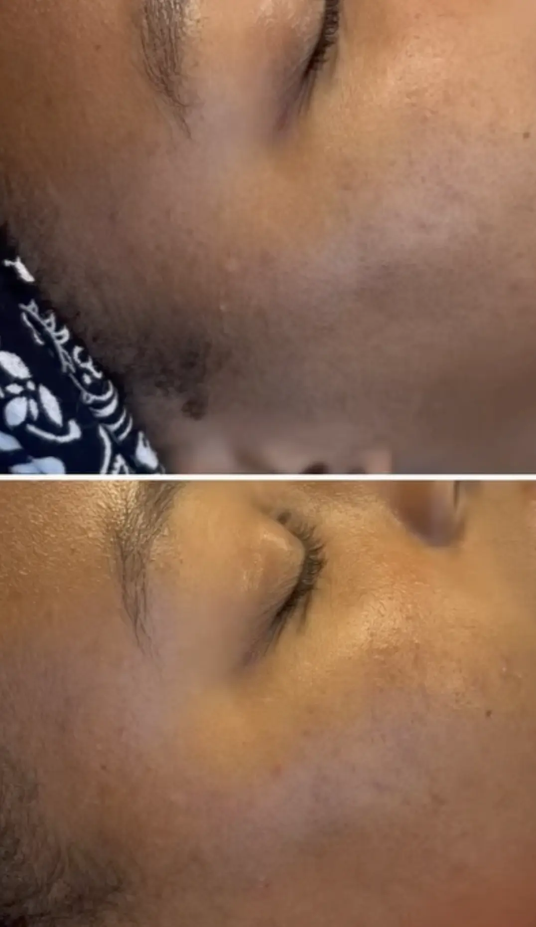 how to manage melasma if you go to the gym