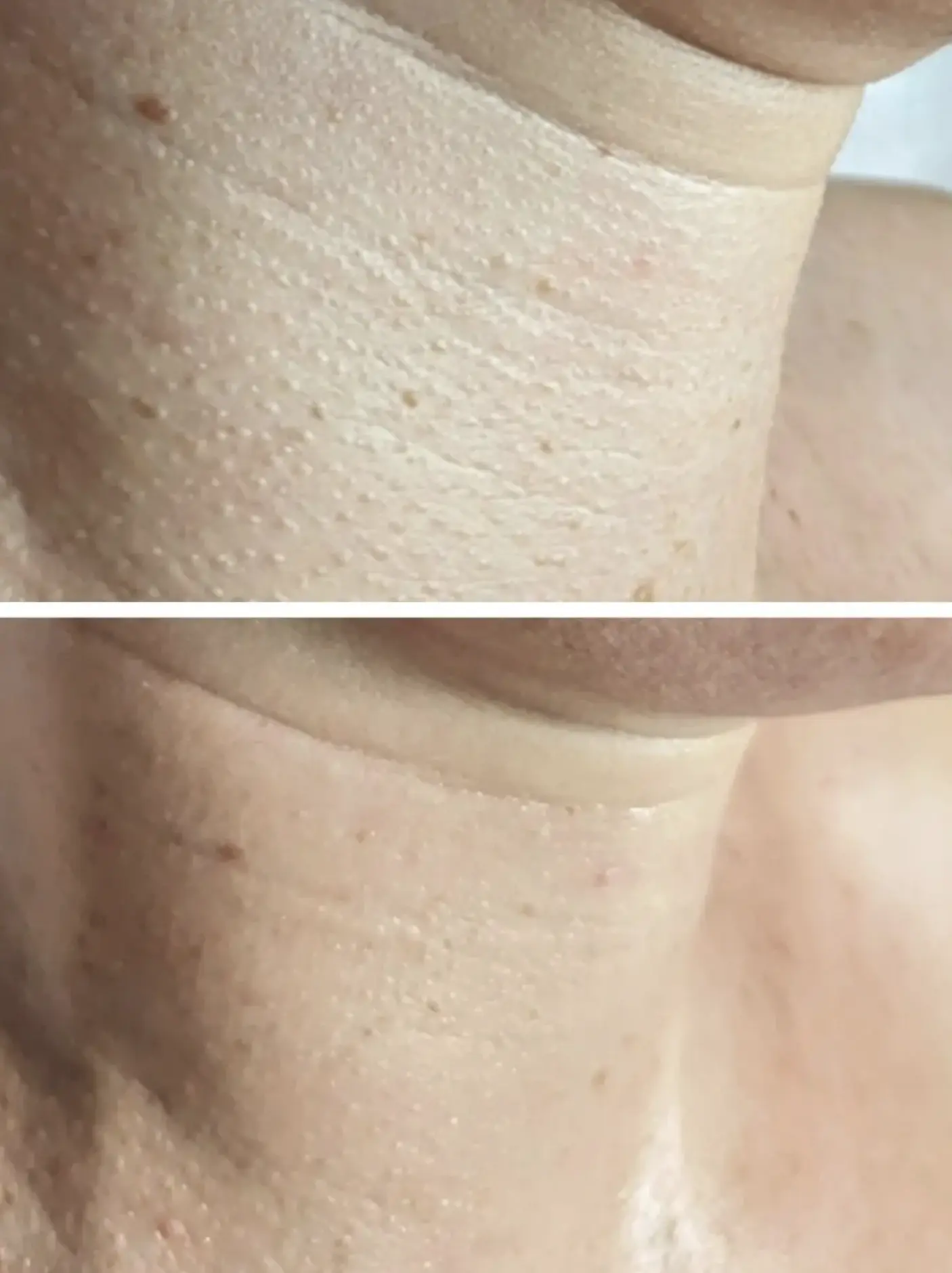 how to tighten loose neck skin without surgery
