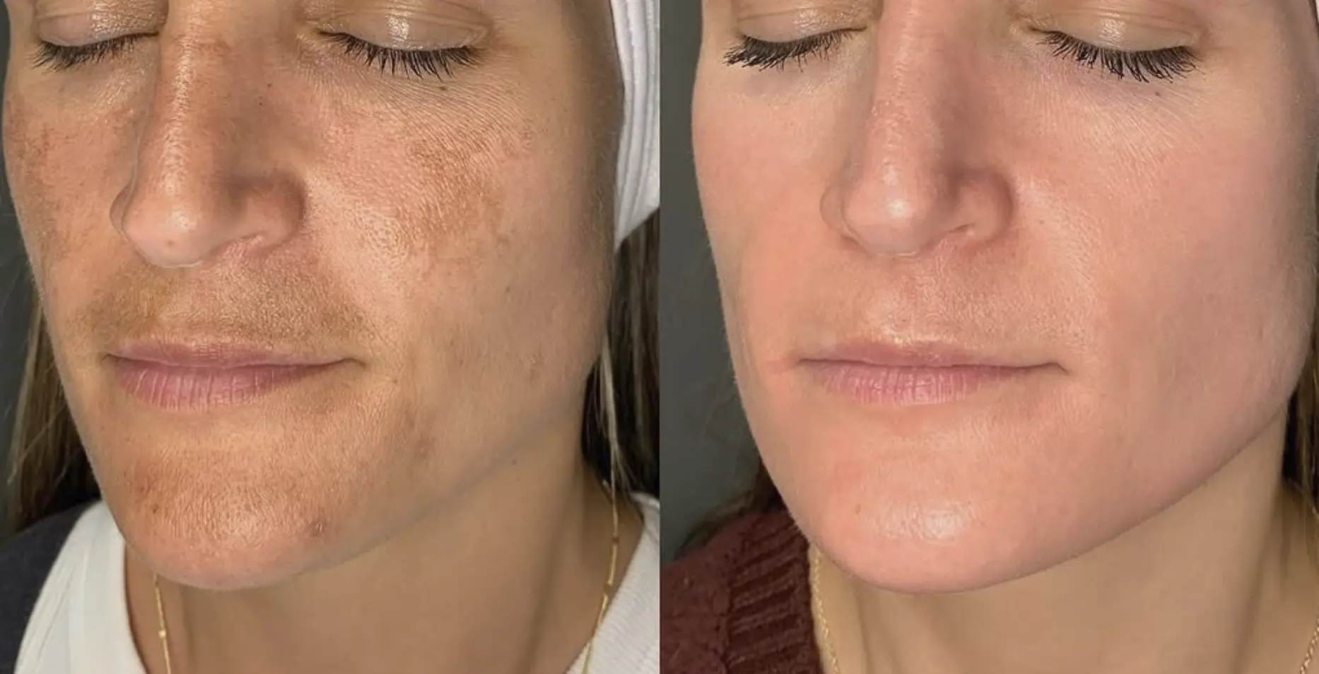 how to treat heat induced melasma from workouts