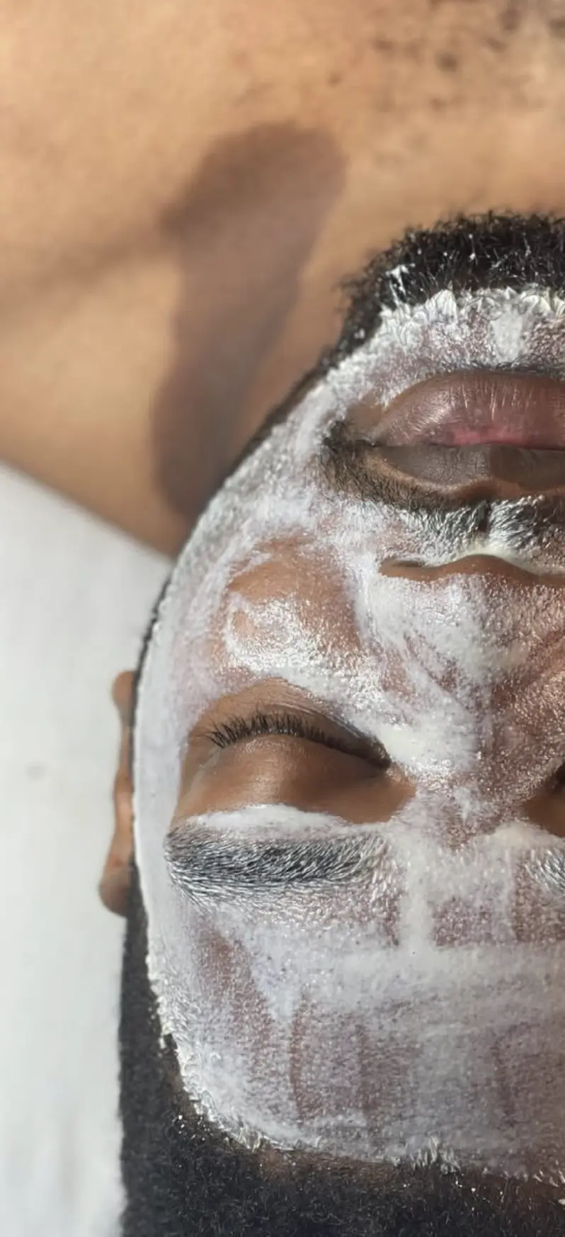 hydrafacial beard area limitations explained