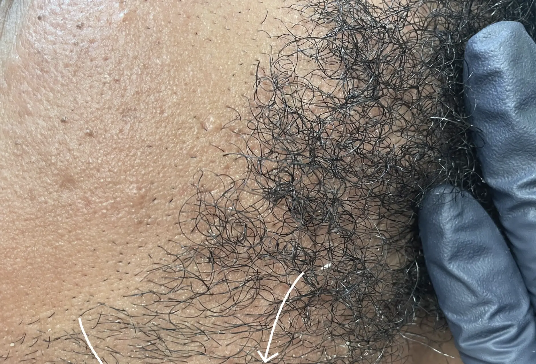 hydrafacial for men with facial hair