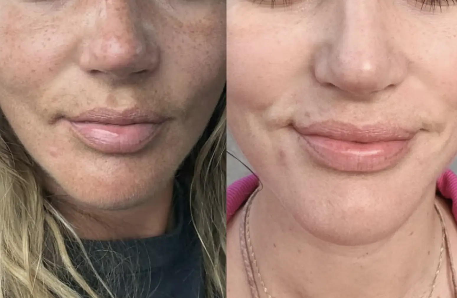 melasma caused by heat and sweating treatment