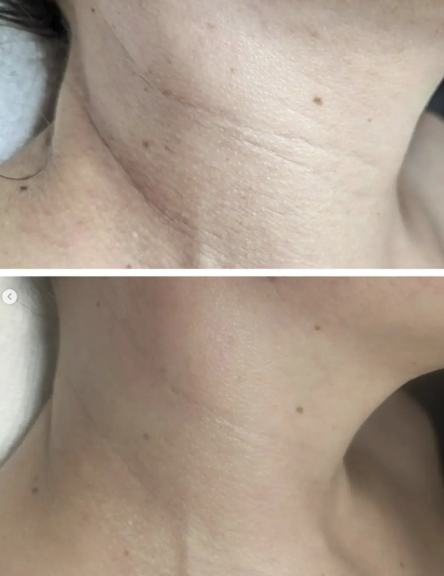 neck tightening treatments after rapid weight loss