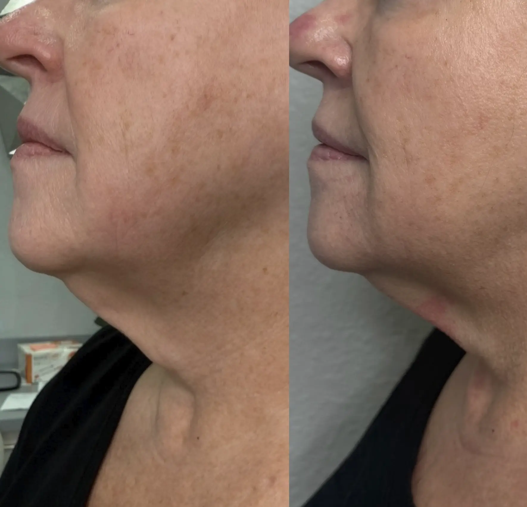 radiofrequency for neck tightening after weight loss