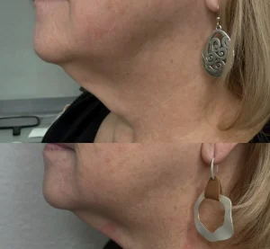 skin tightening treatments for loose neck skin