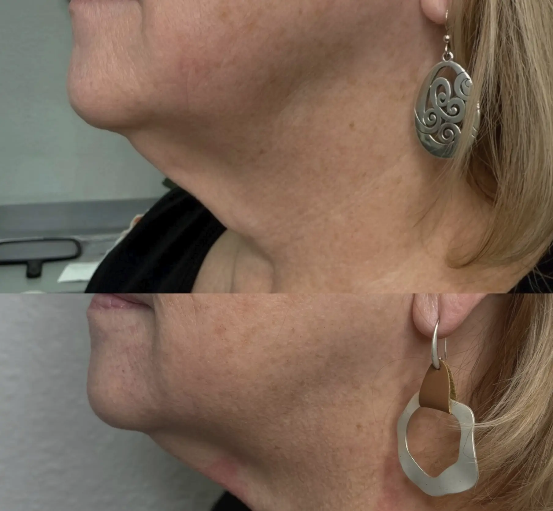 skin tightening treatments for loose neck skin